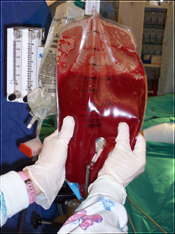 The Hemobag® is able to avoid those precarious 1 & 2 unit blood product transfusions and extend the transfusion trigger.